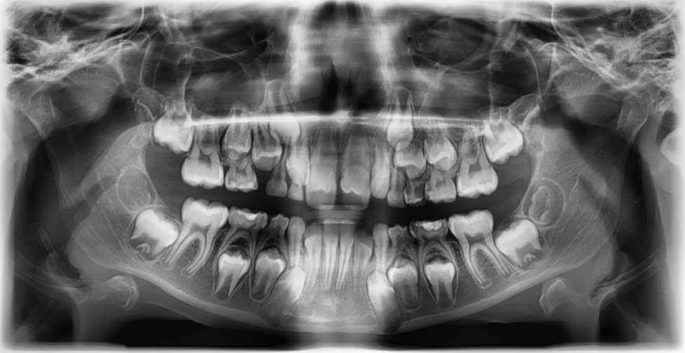 Ортопантомограмма (ОПТГ), рентгеновский снимок, Роден