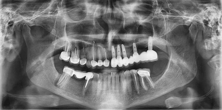 Ортопантомограмма (ОПТГ), Панорамный снимок зубов, Роден