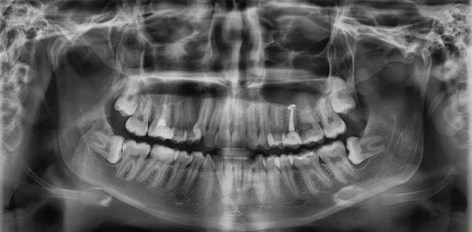 Ортопантомограмма (ОПТГ), рентгеновский снимок, Роден